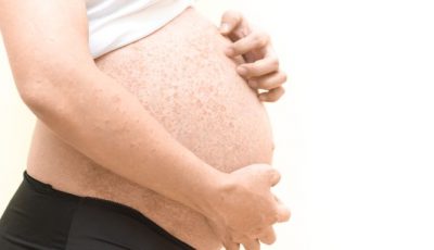 Причины и симптомы поллиноза при беременности и при кормлении грудью