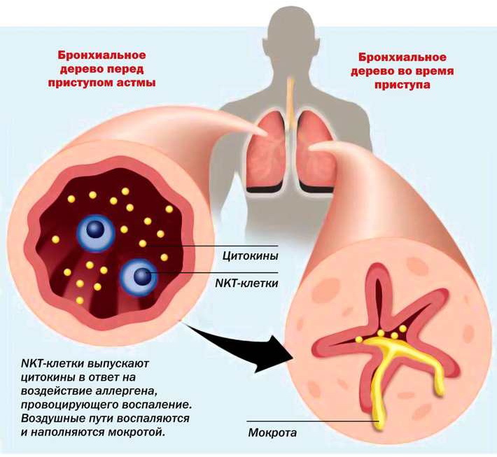 Бронхиальная астма ухудшает качество жизни