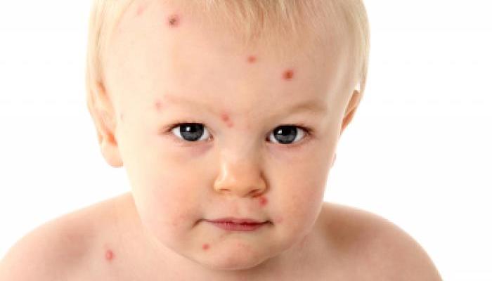 Как проявляется аллергия у детей